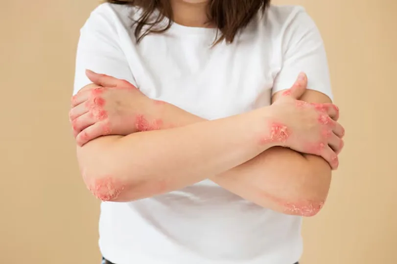 Aprueban en Argentina un innovador tratamiento oral para la artritis psoriásica
