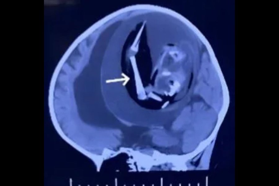 Murió una beba que tenía el feto de su gemelo dentro del cráneo